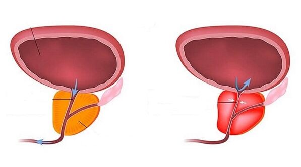 zdravá a zanícená prostata prostatitidou