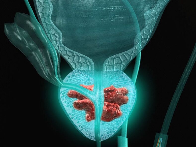 Prostatitida