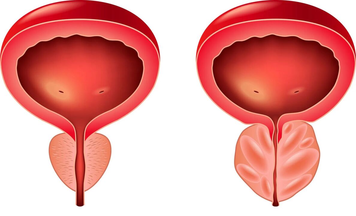 normální a nemocná prostata